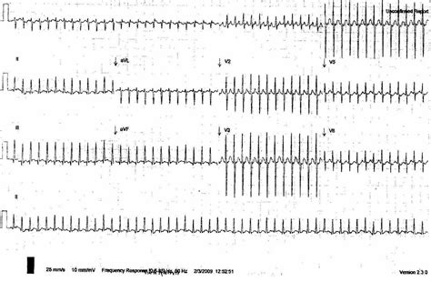 Pr Interval Litfl Medical Blog Ecg Library Basics