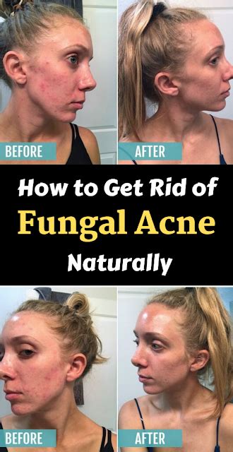 how to get rid of fungal acne naturally at home