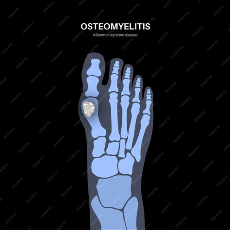 Osteófitos Marginais Nos Corpos Vertebrais 5