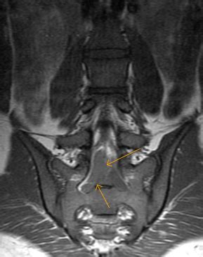 Sacral Neural Tumour-MRI - Sumer's Radiology Blog