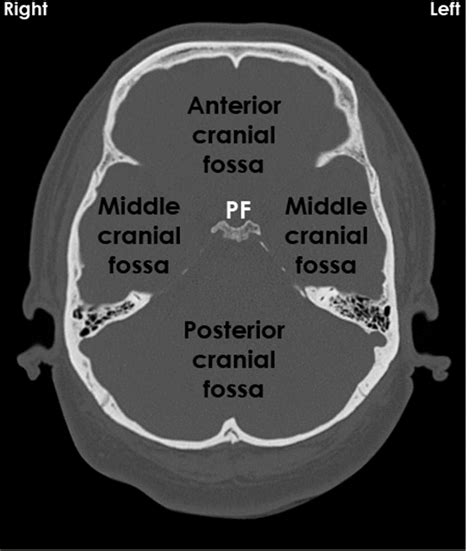interpretation  ncct head normal findings epomedicine