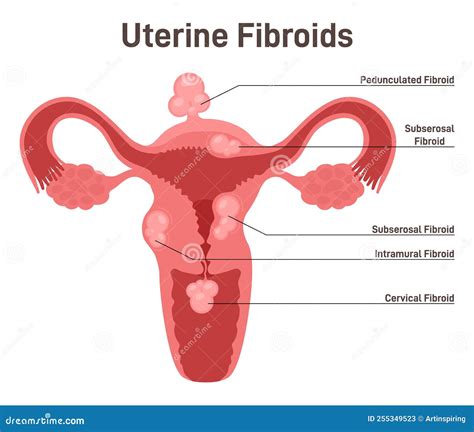 Uterine Fibroid Subserosal Intramural Submucosal And Pedunculated