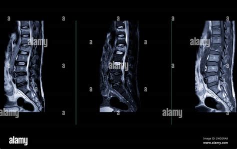 Mri L S Spine Or Lumbar Spine Sagittal View For Diagnosis Spinal Cord