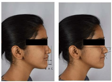 A Nasal Tip Projection Relative To Sagittal Upper Lip Position Ratio