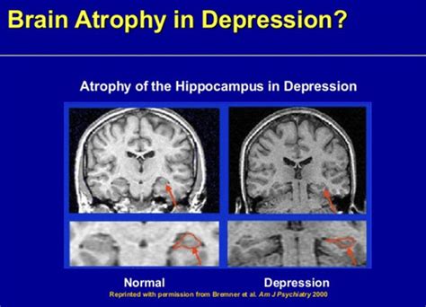 Neuro Lecture 13 Depressive Disorders Depression And Bipolar