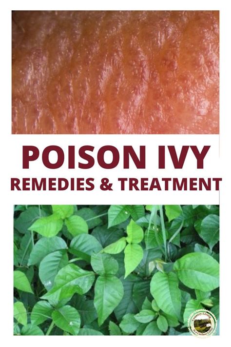 Poison Ivy Rash Symptoms Treatment And Prevention Artofit