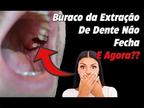 Tirei Os Pontos Do Siso E Ficou Aberto - Pontos Para Extracao De Dente Do Siso Sintomas De Infecção No Dente