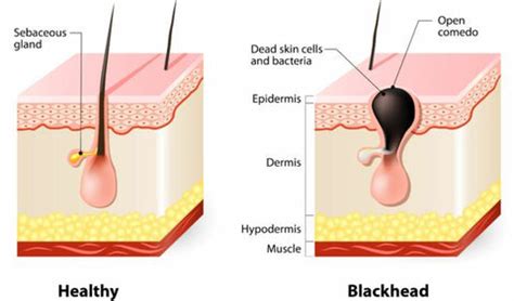 What Causes Blackheads? | Biore Skincare