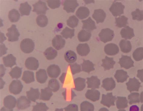 Rbt Gypsi Blood Smear Showing Babesia Sp In Rbc Double Download