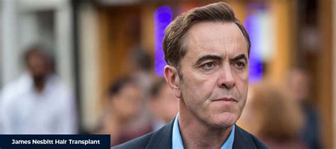 James Nesbitt Hair Transplant Smile Hair Clinic