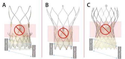 Stent In Valve Implantation Cardiac Interventions Today