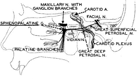 Figure 1 from SPHENOPALATINE GANGLION NEURALGIA | Semantic Scholar