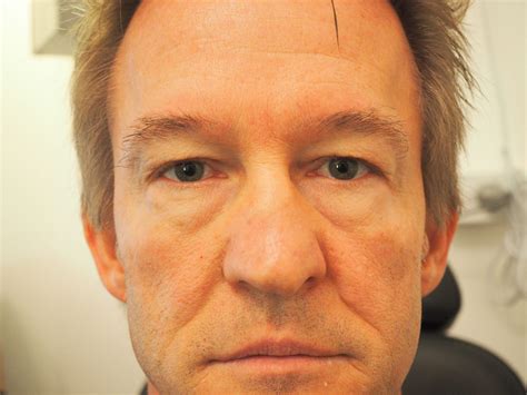 Eyelid surgery - Dr Tom Cunneen - Eye Surgery Perth