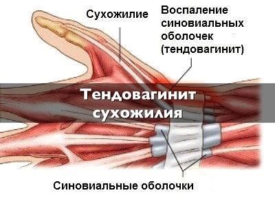 Тендовагинит препараты для лечения