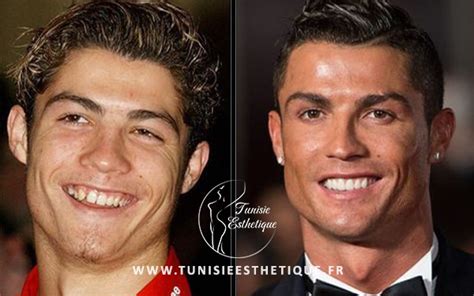 Cristiano Ronaldo Avant La Chirurgie Tunisie Esthetique