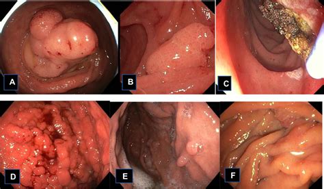 Novel Genetic Causes Of Gastrointestinal Polyposis Syndromes TACG