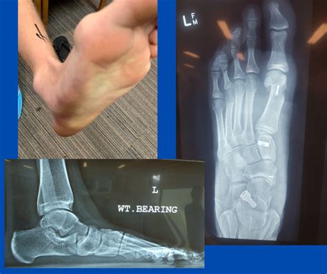 Paediatric Rigid Flat Foot Dr Damien Lafferty
