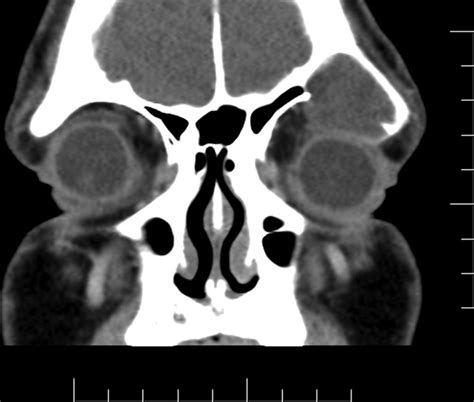 Osteoplastic Obliteration Of The Frontal Sinus Clinical Tree