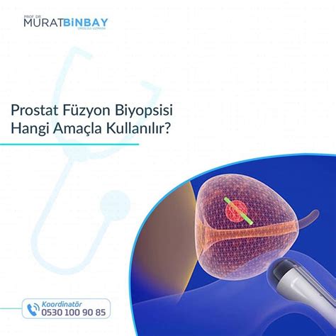 Prostat Füzyon Biyopsisi Prostat Kanserinin Kesin Tanısı Için Gerekli Olan Bir Uygulamadır