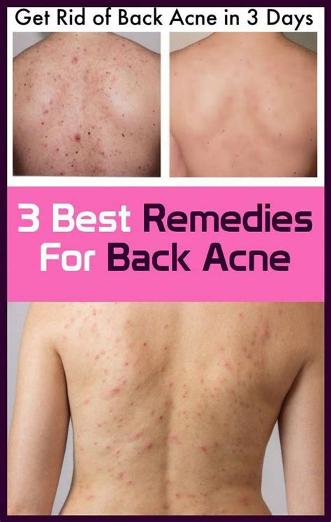 3 Best Remedies For Back Acne Back Acne Remedies Best Acne Remedies Acne Remedies