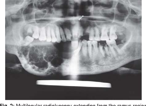 Ameloblastoma X Ray