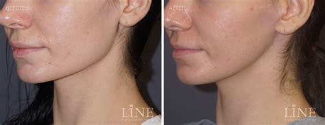 Shaving After Jaw Surgery at Eliza Pethebridge blog