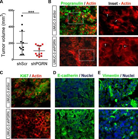 Progranulin Regulates Orthotopic Bladder Tumor Formation A Tumor