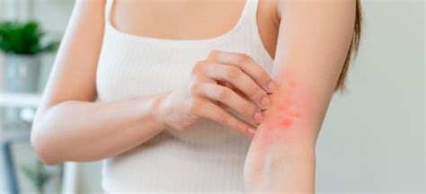 How To Treat Eczema On Elbows