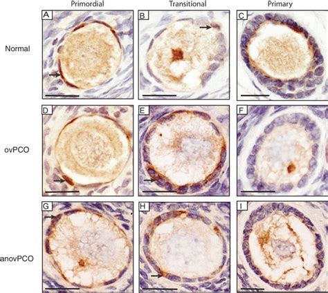 Light Micrographs Illustrating The Presence Of IGFR 1 Protein Brown