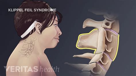 Klippel-Feil Syndrome (KFS): What Is It, Symptoms, Causes, 50% OFF