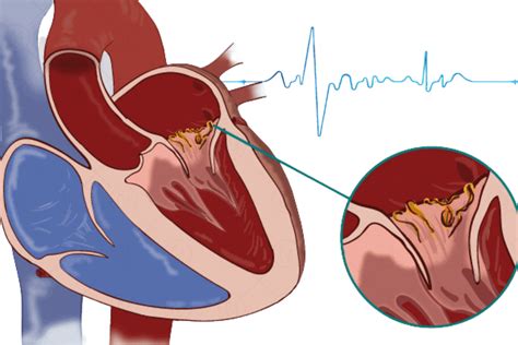 What Is Endocarditis Symptoms And Causes Dr Raghu 42 Off