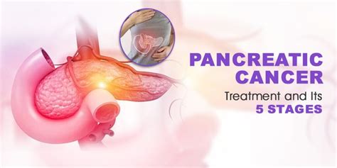 Pancreatic Cancer Treatment and Its 5 Stages