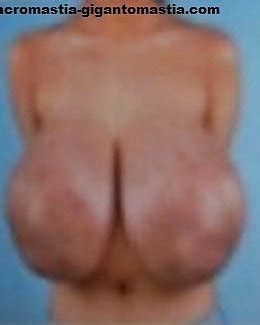 Macromastia Porn Pictures Xxx Photos Sex Images Pictoa