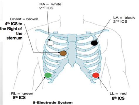 ecg interpretation flashcards quizlet
