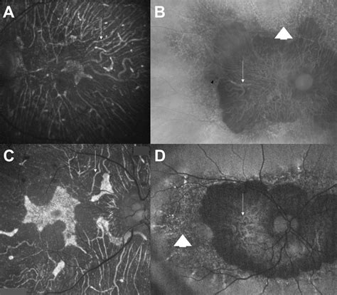 Autofluorescence Of Choroidal Vessels In Biettis Crystalline Dystrophy