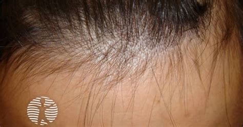 Alopecia From Drugs Image