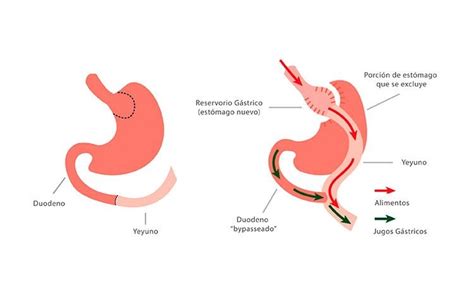 Bypass Gastrico En Y De Roux Laparoscopico Lrygb Cirug A