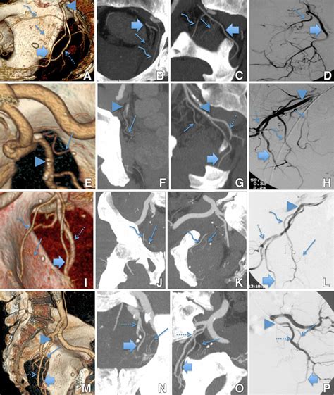 Prostatic Artery Straight Small Arrow Origin A D As A Collateral