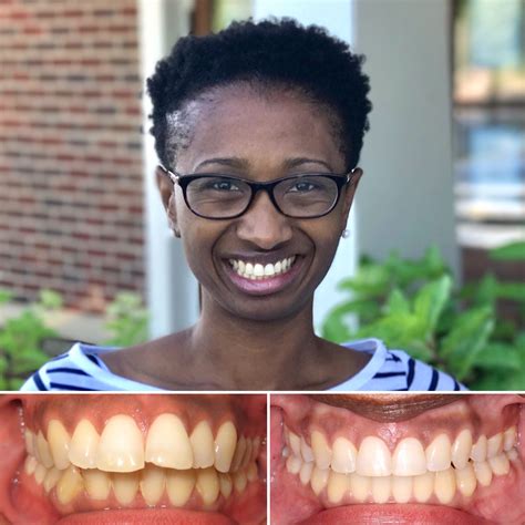 Before And Afters Saddle Creek Orthodontics Germantown Braces