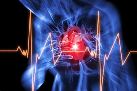 L Infarto E L Arresto Cardiaco Sono Due Cose Differenti