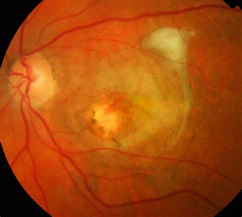 Myopic Maculopathy Vision Study - mivision