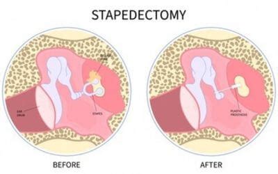 STAPEDECTOMY – Fort Hospitals