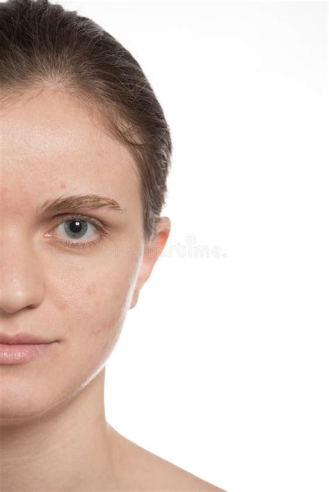 Beautiful Girl With Red And White Acne On Her Face Stop Acne On Stock