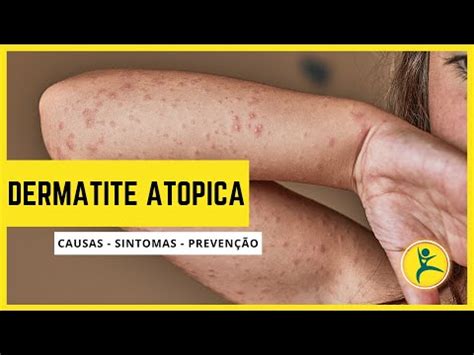 O Que é DERMATITE ATOPICA Saúde Bem Estar Hoje