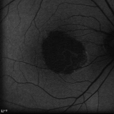 Geographic atrophy - Retina Image Bank