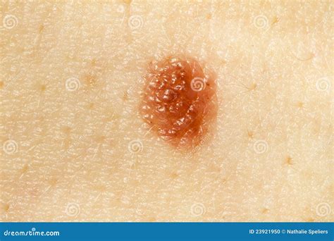 Skin Mole Macro Stock Photo Image Of Derma Health Medical 23921950