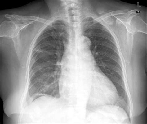 Apical Pleural Thickening