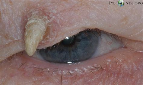 atlas entry cutaneous horn