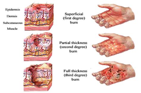 Burn Injuries Flashcards Quizlet