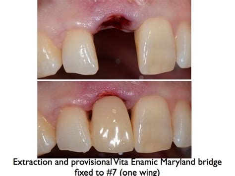 One Wing Maryland Bridge With Two Wings I Cdocs Dental Blog Cdocs